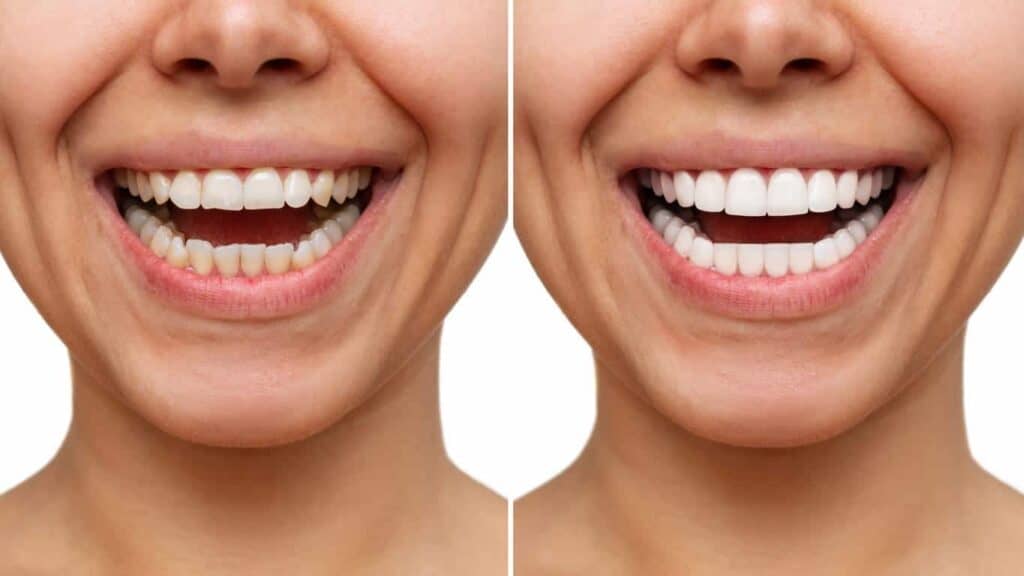 Before and after teeth whitening results. Banbury